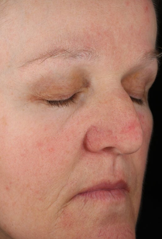 Rozatrol | Redness & Rosacea Serum | ZO Skin Health, Inc.